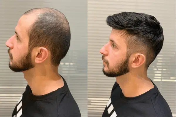 prótese capilar