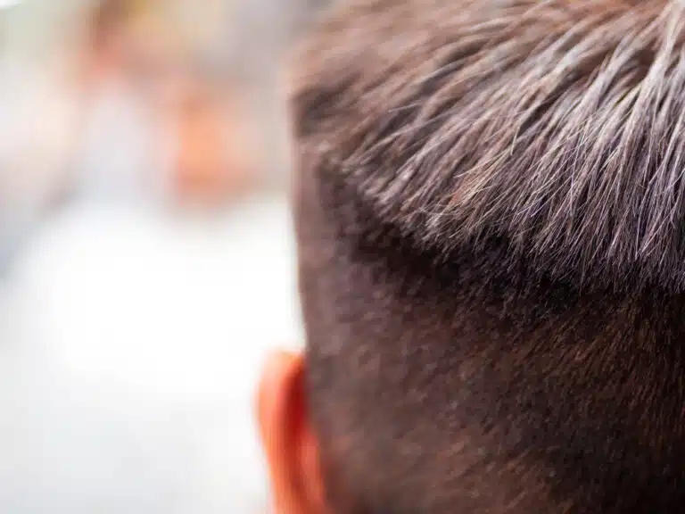 Prótese Capilar Masculina: Recuperando a Autoestima e Combatendo a Calvície Prótese capilar